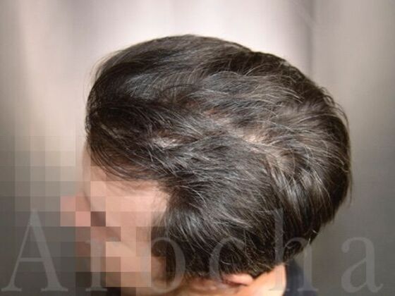 FUT Hair Restoration: Case 39 - After