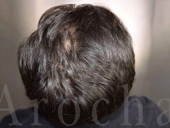 FUT Hair Restoration: Case 39 - After