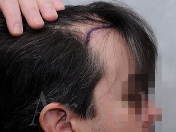 FUT Hair Restoration: Case 39 - Before