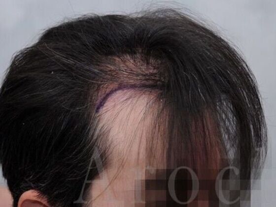 FUT Hair Restoration: Case 39 - Before