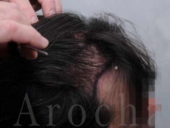 FUT Hair Restoration: Case 39 - Before