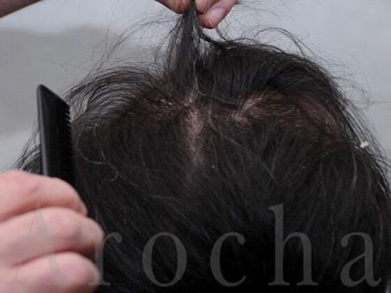 FUT Hair Restoration: Case 39 - Before