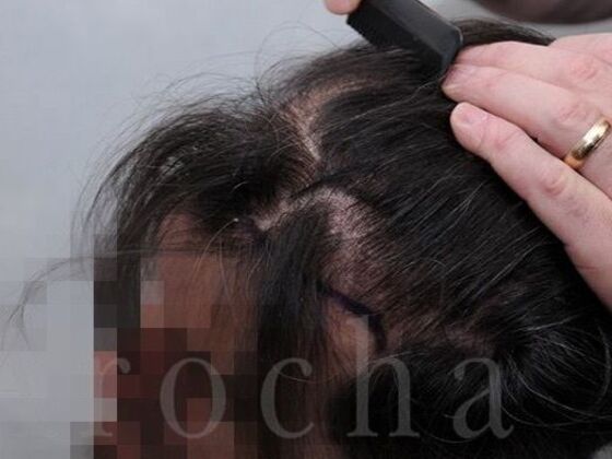 FUT Hair Restoration: Case 39 - Before