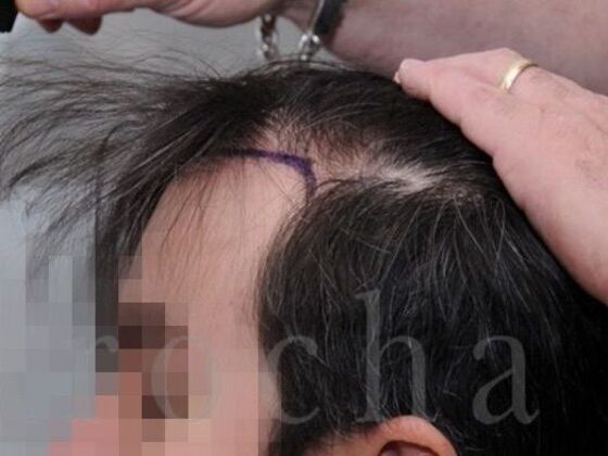 FUT Hair Restoration: Case 39 - Before