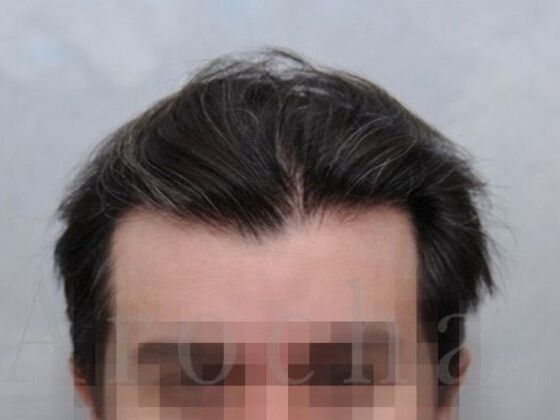 FUT Hair Restoration: Case 39 - Before