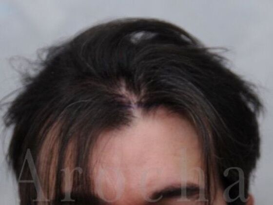 FUT Hair Restoration: Case 39 - Before