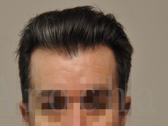 FUT Hair Restoration: Case 39 - After