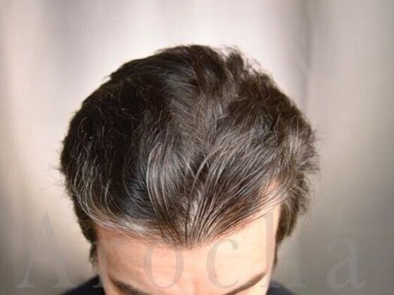 FUT Hair Restoration: Case 39 - After