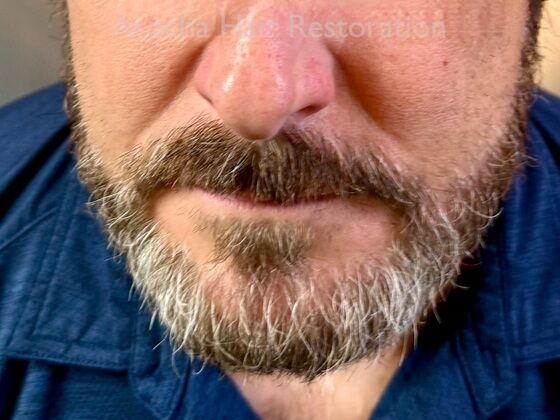 Facial Hair Transplantation Case 15 - After