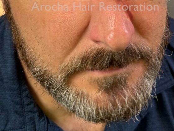Facial Hair Transplantation: Case 15 - After