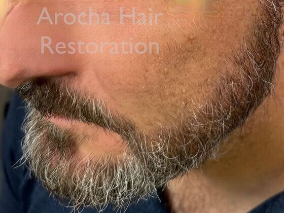 Facial Hair Transplantation: Case 15 - After