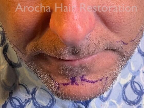 Facial Hair Transplantation Case 15 - Before