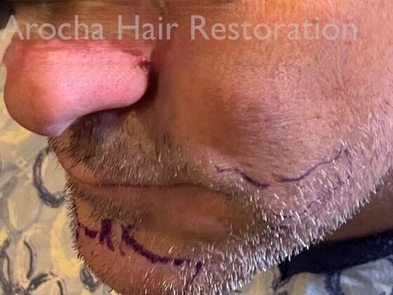 Facial Hair Transplantation: Case 15 - Before