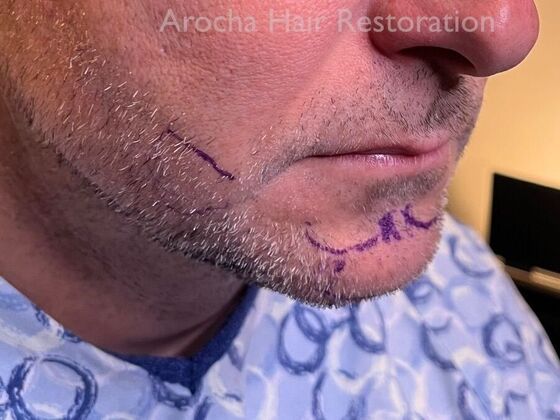 Facial Hair Transplantation: Case 15 - Before