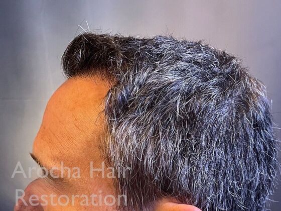 FUE Hair Restoration: Case 34 - Before