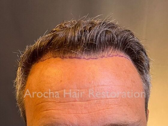 FUE Hair Restoration: Case 34 - Before