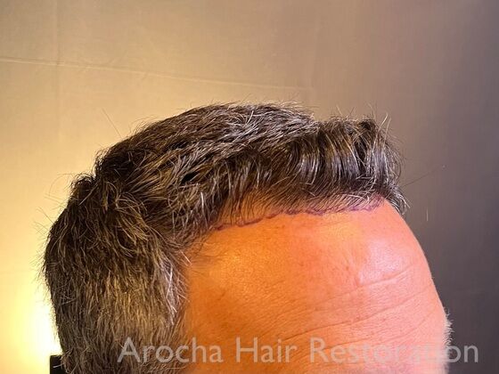 FUE Hair Restoration: Case 34 - Before