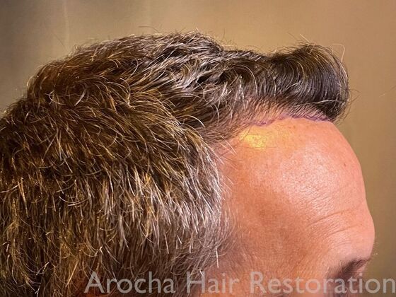 FUE Hair Restoration: Case 34 - Before