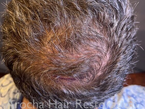 FUE Hair Restoration: Case 34 - Before