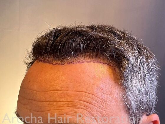 FUE Hair Restoration: Case 34 - Before