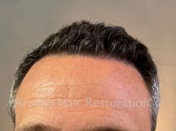 FUE Hair Restoration: Case 34 - After