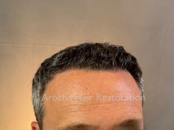 FUE Hair Restoration: Case 34 - After