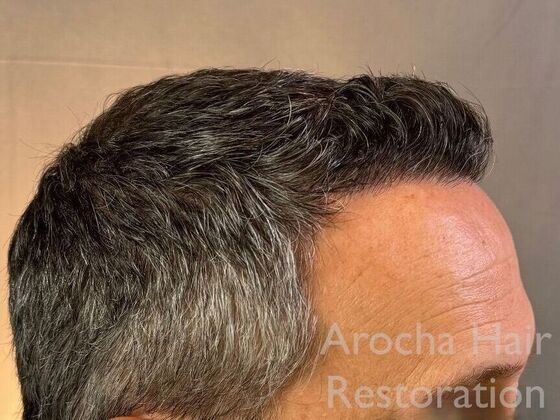 FUE Hair Restoration: Case 34 - After