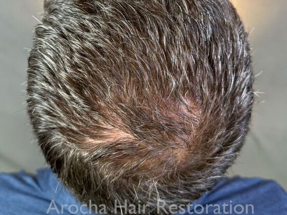 FUE Hair Restoration: Case 34 - After