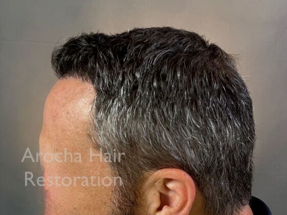 FUE Hair Restoration: Case 34 - After