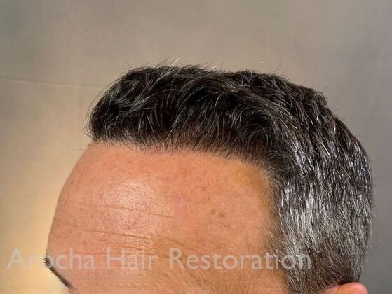 FUE Hair Restoration: Case 34 - After