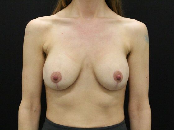 Breast Revision Case 2 - After