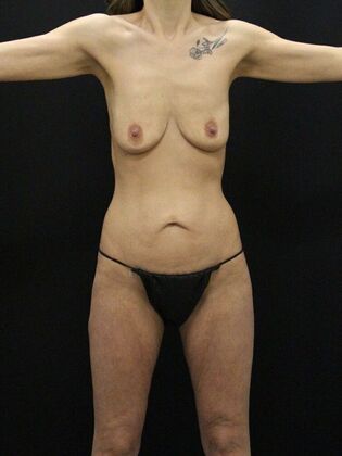 Tummy Tuck: Case 31 - Before