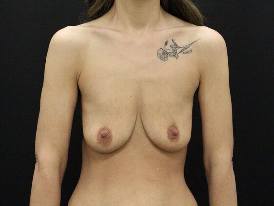 Breast Lift & Breast Lift Augmentation Case 17 - Before