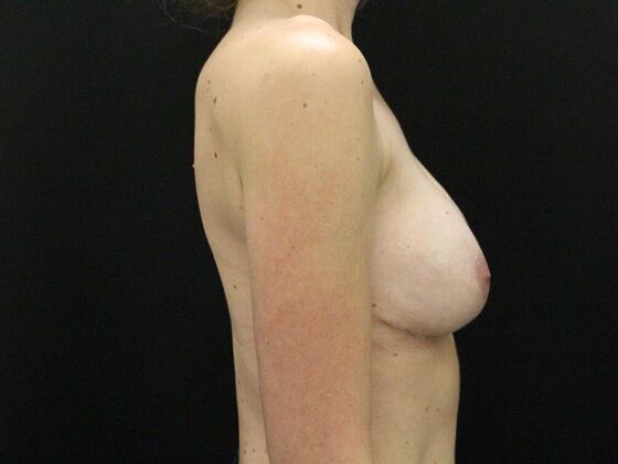 Breast Revision: Case 3 - After