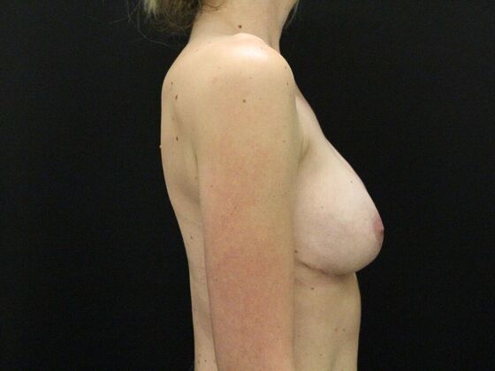 Breast Lift & Breast Lift Augmentation: Case 18 - After