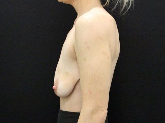 Breast Lift & Breast Lift Augmentation: Case 20 - Before