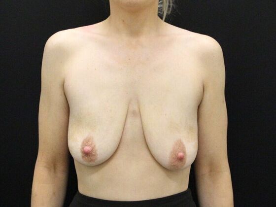 Breast Lift & Breast Lift Augmentation Case 20 - Before