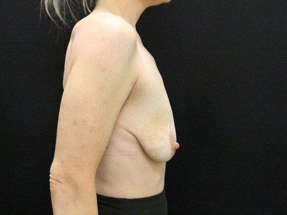 Breast Lift & Breast Lift Augmentation: Case 20 - Before
