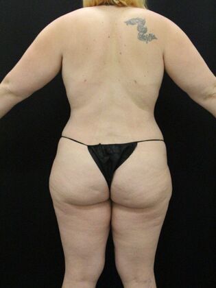 Liposuction Case 26 - After