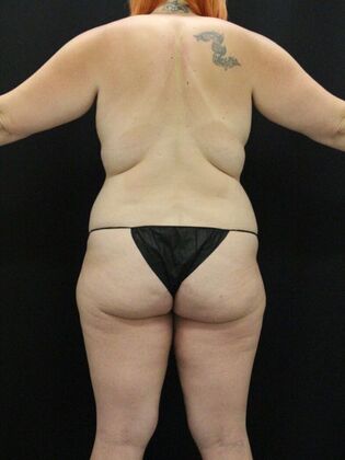 Liposuction Case 26 - Before