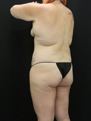 Liposuction: Case 26 - Before