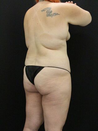 Liposuction: Case 26 - Before