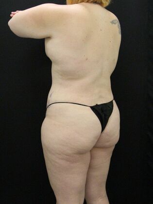 Liposuction: Case 26 - After