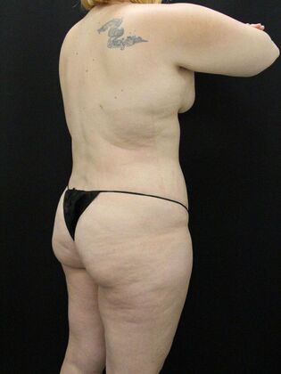 Liposuction: Case 26 - After