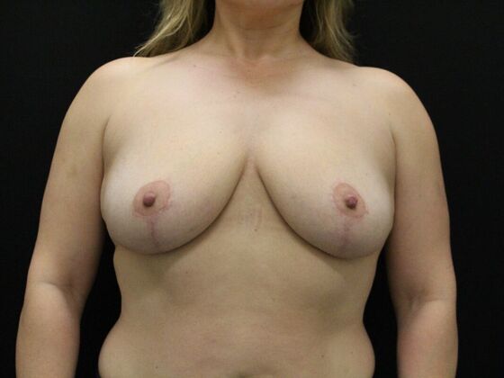 Breast Reduction & Lift Case 10 - After