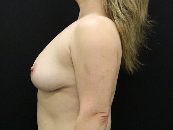 Breast Lift & Breast Lift Augmentation: Case 22 - After