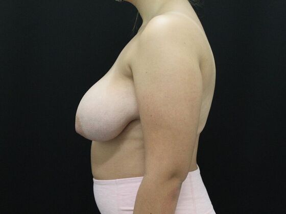 Breast Reduction & Lift: Case 11 - Before