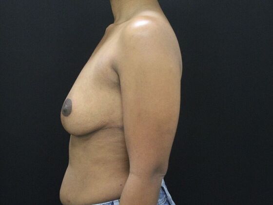 Breast Reduction & Lift: Case 12 - After