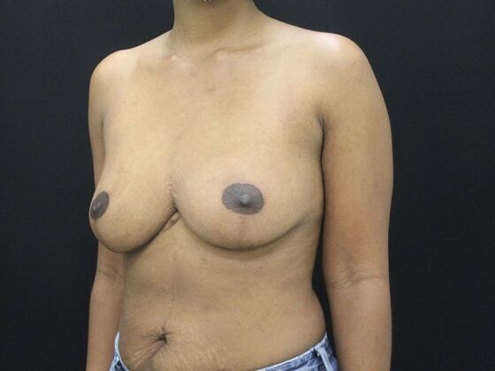 Breast Reduction & Lift: Case 12 - After