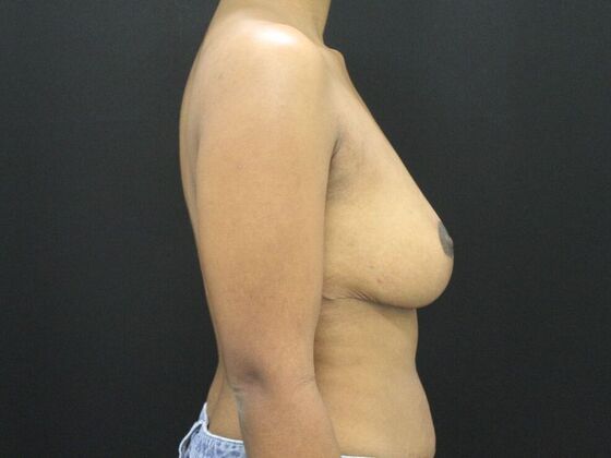 Breast Reduction & Lift: Case 12 - After